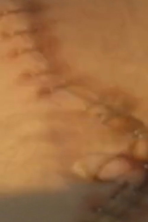 Suite: Double Nephrectomy